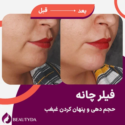 chin-filler-injectio-2