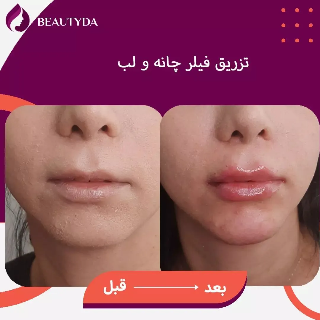 Chin and lip injection2